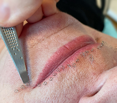 MESO ACULIFTING MASTERCLASS