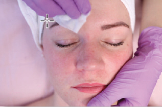 Step 1 &mdash; Meso Pure Peel