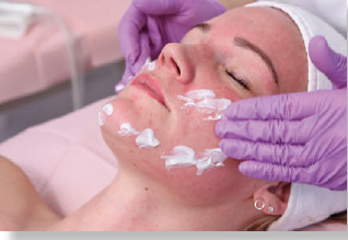 Step 5 &mdash; Meso Lift & Protect