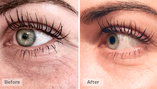 Eye area &mdash; treatment