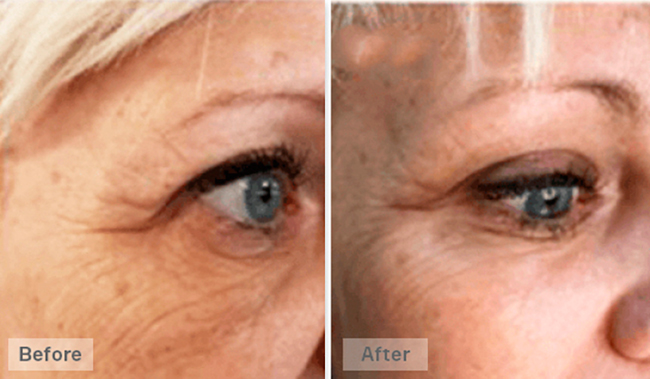 Eye area &mdash; results