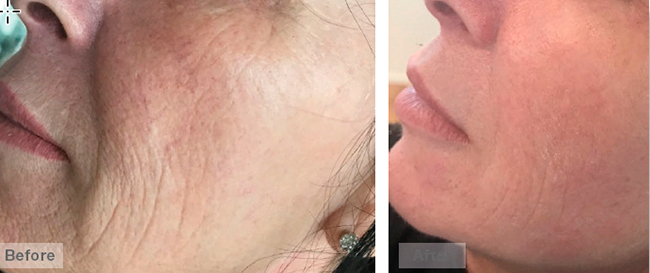 Face treatment &mdash; non‑invasive
