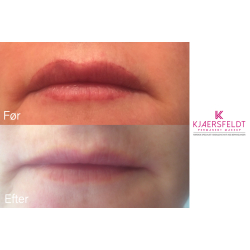 Become educated tattoo and permanent makeup removal (Non laser)