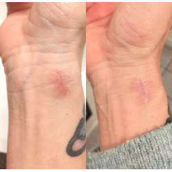 Course in scar correction and 3D areola (Combined online teaching and practice)