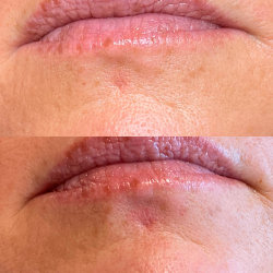 Course in scar correction and 3D areola (Combined online teaching and practice)