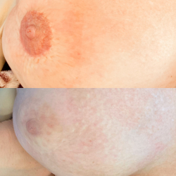 Course in scar correction and 3D areola (Combined online teaching and practice)