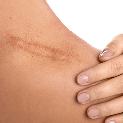 Course in scar correction and 3D areola (Combined online teaching and practice)