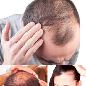 MESO HAIR GROWTH CONCEPT+ (Product package)