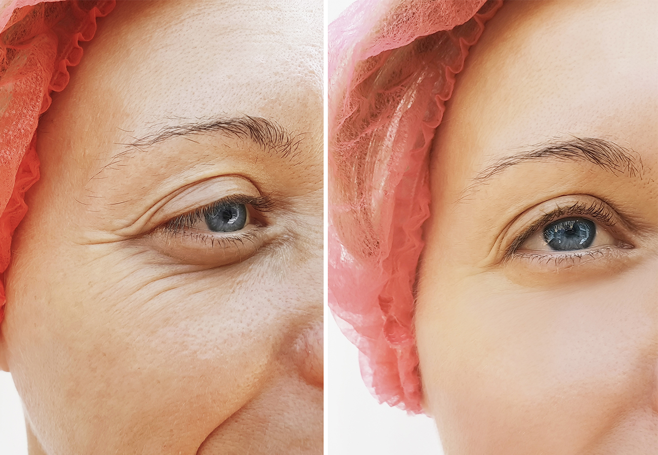 MALAR & PERIORBITAL ZONE