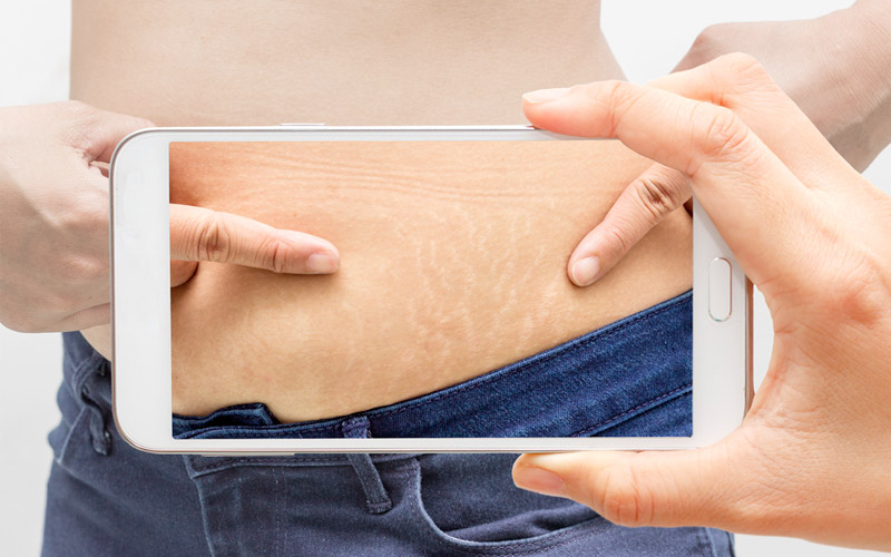 Stretch-marks