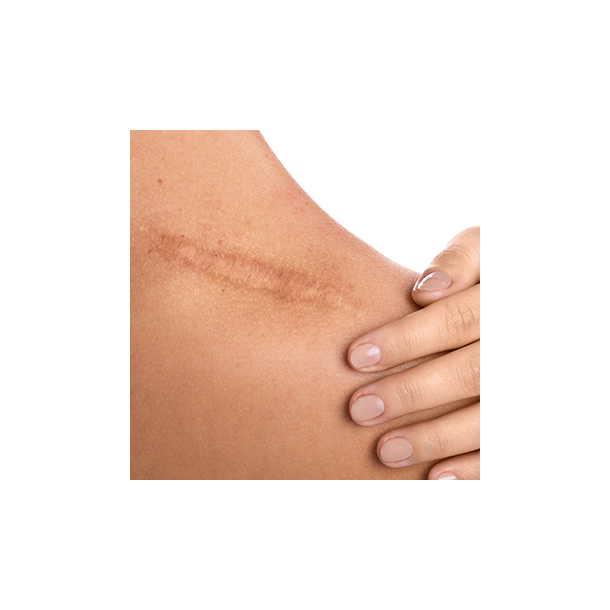 3D areola reconstruction and scar camouflage 